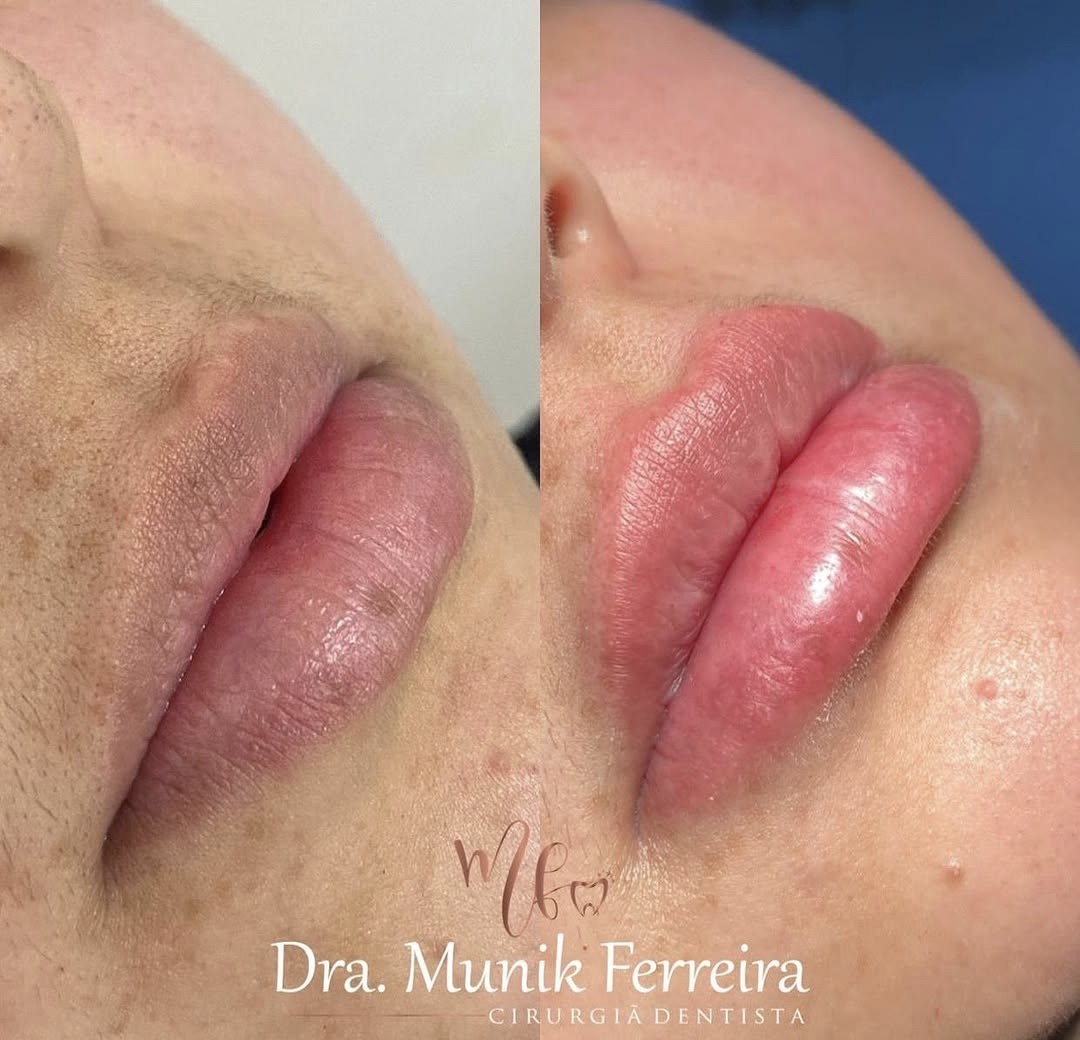 Resultado de preenchimento labial